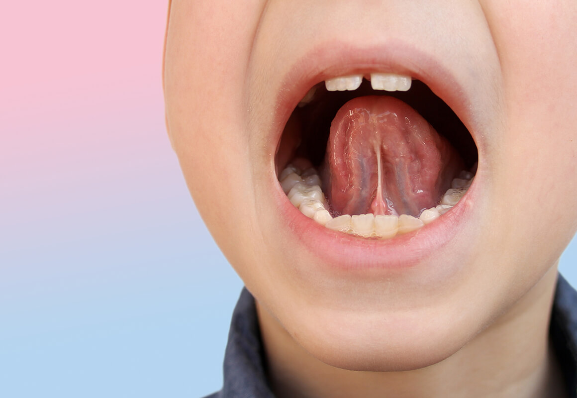 舌のトレーニングで歯並び改善を目指します